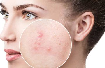 acnee-tatament_8