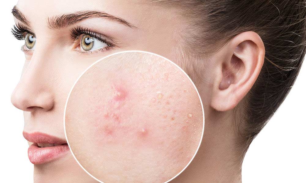 Ai acnee facială și vrei ajutor REAL + bani?