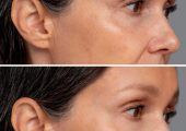 Toxina botulinica – interventii de succes la Clinica Estet Laser