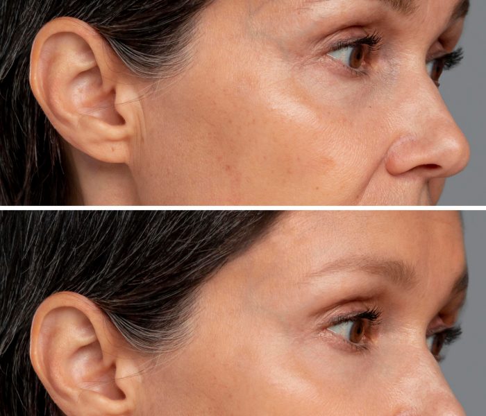 Toxina botulinica – interventii de succes la Clinica Estet Laser